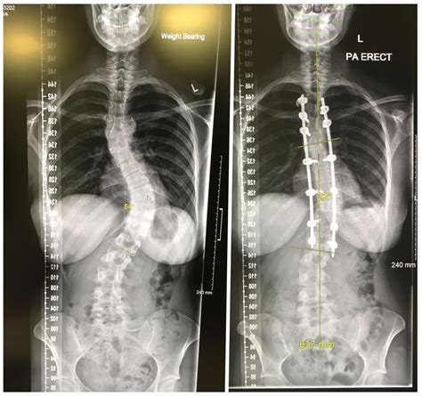 Before and after my scoliosis spinal fusion :) [OC] : XRayPorn