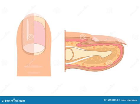 Anatomy of a Fingernail Diagram, nail groove