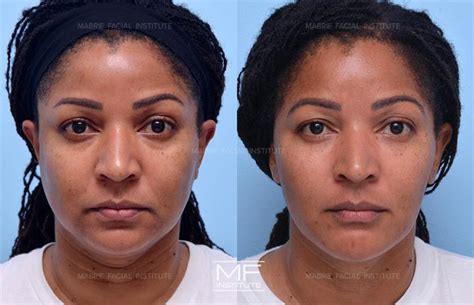 Juvederm Cheekbones