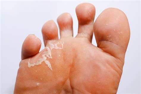 What is Athlete's Foot | How to Get Rid of Athlete's Foot