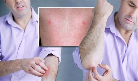 Measles rash: Five symptoms to look out for after ‘ongoing large outbreaks’ in UK | Express.co.uk