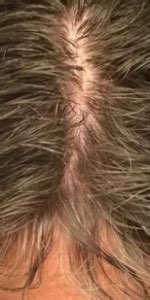 Thinning hair after menopause – WRassman,M.D. BaldingBlog