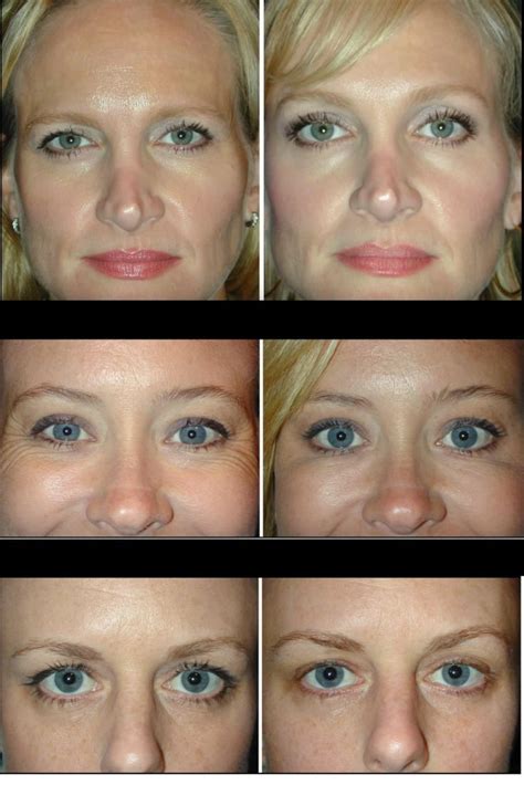 Botox for an eyebrow lift? You would be amazed at the results, and how ...