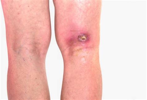 Venous Ulcers - Leg Ulcers - Arterial Disease | Houston, Tx