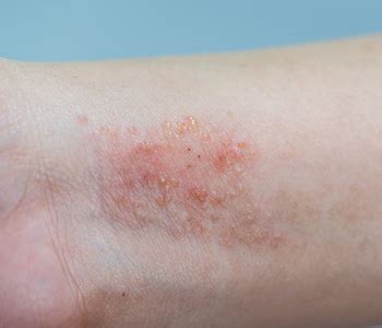 Skin Rashes That Itch : Pin on Dermatitis / Necrotizing fasciitis is a bacterial infection most ...