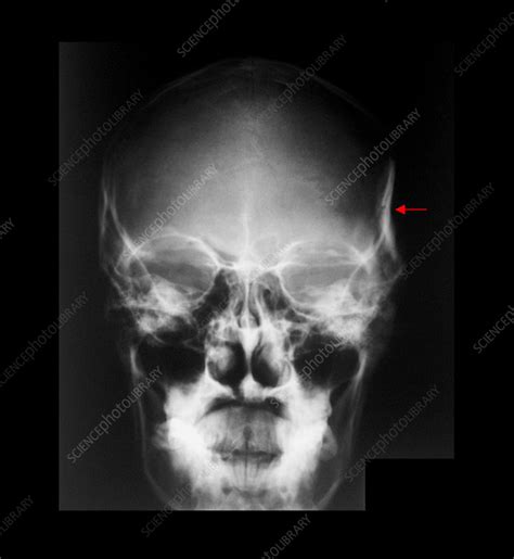 X-Ray of Skull Fracture - Stock Image - M330/1627 - Science Photo Library