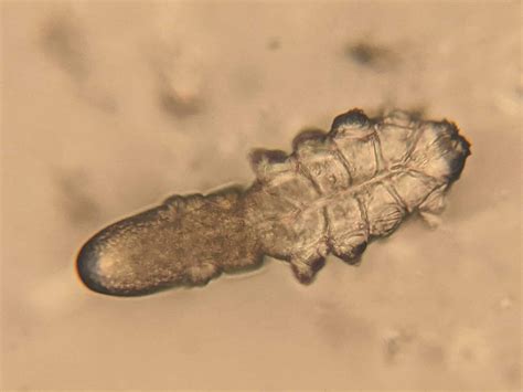 Demodex infestation: Diagnosis and management - Insight