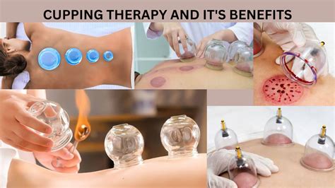 Cupping therapy and its benefits - Physiofitfinder