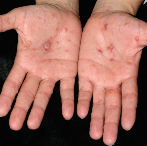 What Is Dyshidrotic Eczema Blisters On Fingers Hands - vrogue.co
