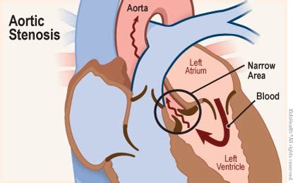 Aortic Stenosis | Rady Children's Hospital