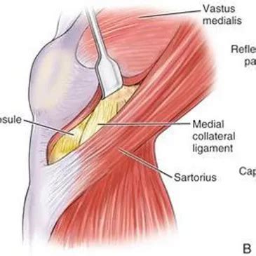 Jiffy Knee Simplified: Minimal Pain, Quick Recovery Surgery