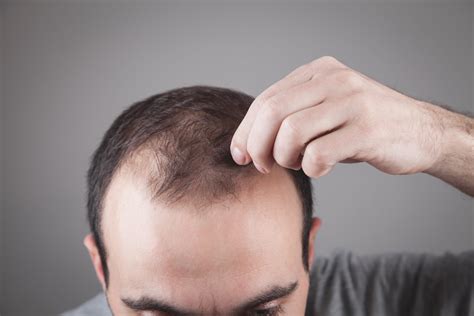 What is the relationship between Hypothyroidism and hair loss?