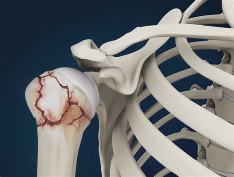 Shoulder Replacement Frisco TX | Shoulder Arthroscopy Frisco TX