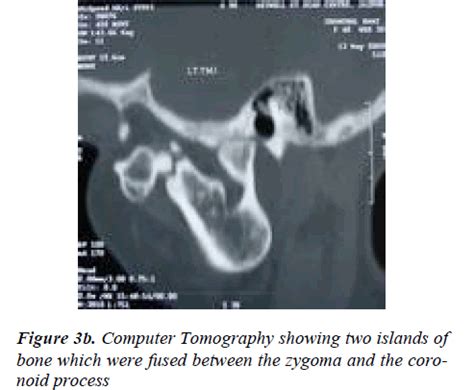 Heterotopic Calcification: A cause for Z | Biomedical Research