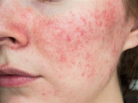 Looking into Rosacea and Vitamin Deficiency - SL Aesthetic Clinic