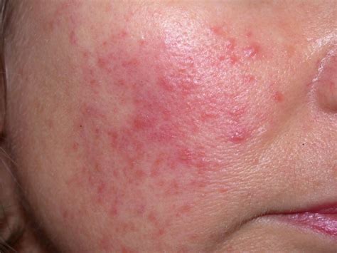Itch or Non-Itchy Red Face Rash Causes and Treatments - American Celiac
