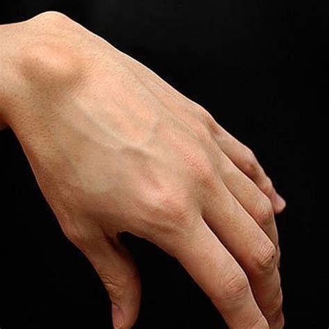 Ganglion Cyst Palm Wrist