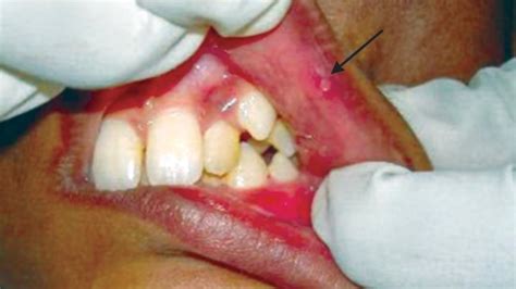 What Causes Lupus Mouth Sores or Ulcers?