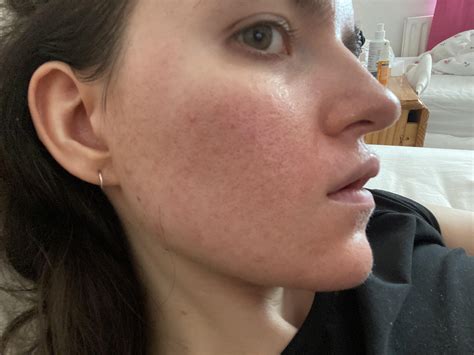 Sebaceous dermatitis? : r/SebDerm