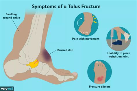 Explore What Talus Fractures Are and Why They Occur | Fractures, Avulsion fracture, Bones of the ...