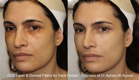 co2 laser for under eye bags - Cosmetic Surgery Tips