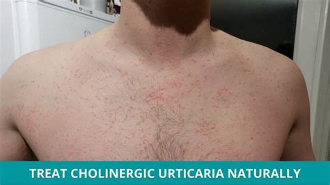 Cholinergic Urticaria