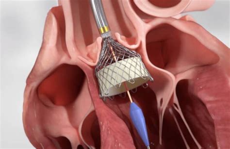 FDA approves two clinical trials for HLT's TAVR system - MassDevice