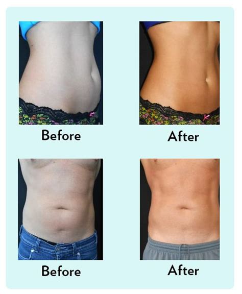 17 Best images about Coolsculpting Before and After on Pinterest | Sculpting, 1 month and Photos of