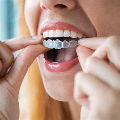 The Pros and Cons of At-Home Teeth Aligners, According to a Dentist ...