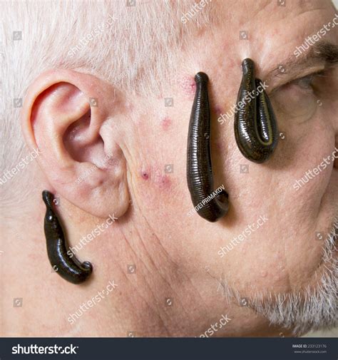 Leech Therapy For Senior Man Stock Photo 233123176 : Shutterstock