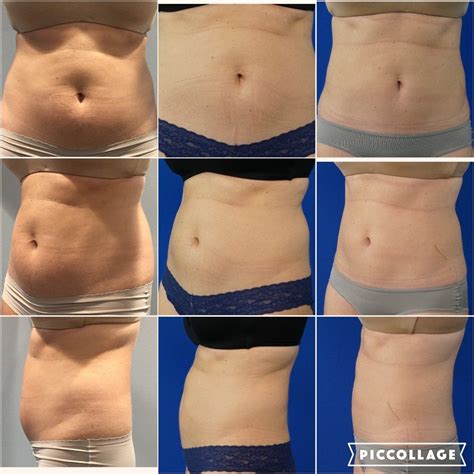 MY COOLSCULPTING JOURNEY – One Small Blonde | Dallas Fashion Blogger