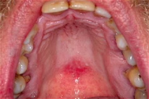 Median Rhomboid Glossitis | Pocket Dentistry