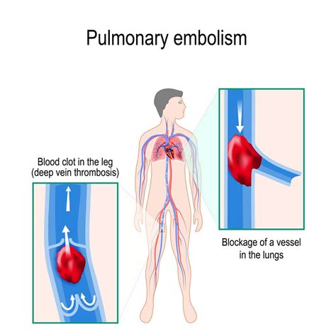 What is A Pulmonary Embolism? - Health Beat