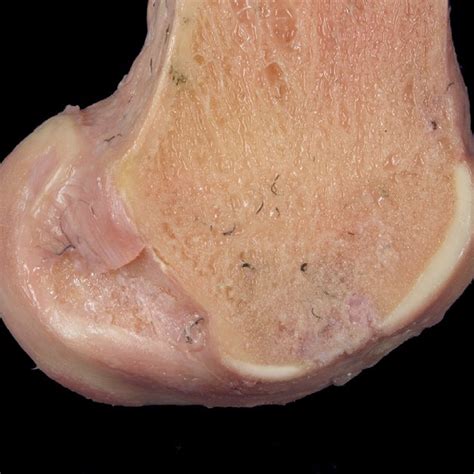 Sagittal section of the lateral femoral condyle showing a cartilage... | Download Scientific Diagram