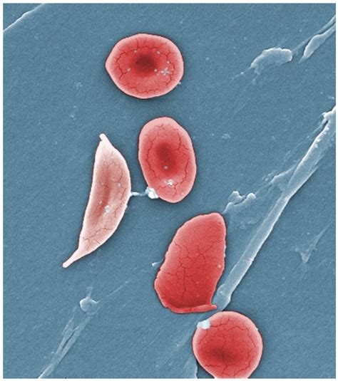 Anemia, Sickle Cell; Hemoglobin S Disease