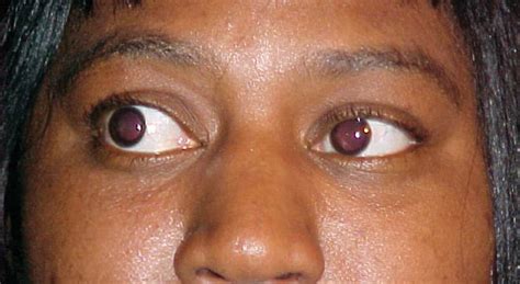 Pictures Of Eyes With Graves Disease - Captions Trendy