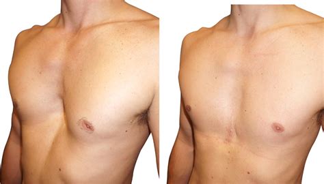 Pectus Excavatum : Résultat avant après de l'opération par implants 3D