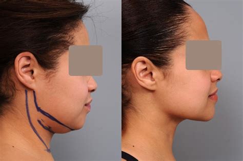 Smartlipo™ Neck Liposuction in NYC - Dr. Sterry