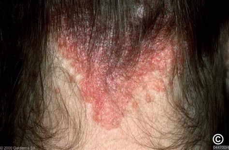 Minor Scalp Psoriasis