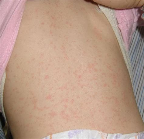 Viral Rashes In Babies