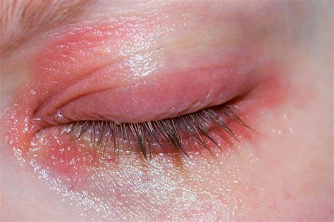 What Is Blepharitis (Eyelid Inflammation)?