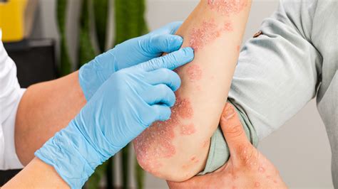 Why Scientists Are Turning To Dust Mite Extract To Treat Eczema