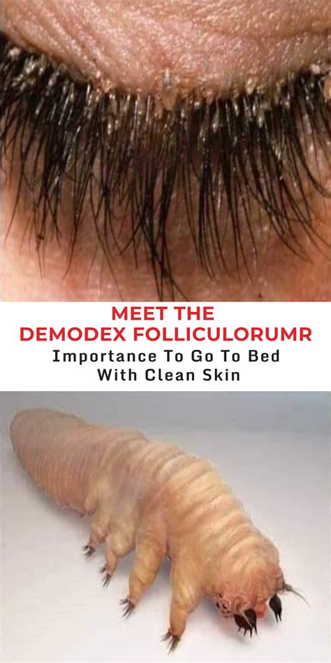 Meet the Demodex Folliculorum-Importance of removing your make-up. | Demodex, Itchy eyelids ...