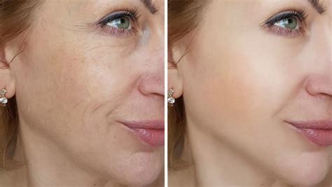 Non-invasive Skin Tightening San Diego | Pellevé in La Jolla