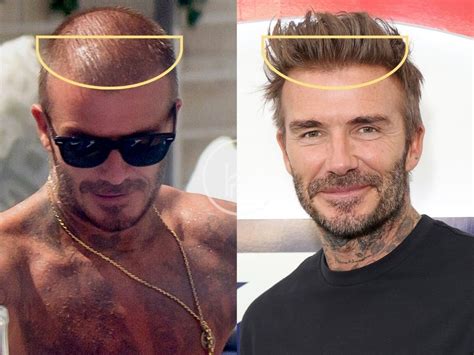 David Beckham Hair Transplant - Hair Loss & Technical Analysis