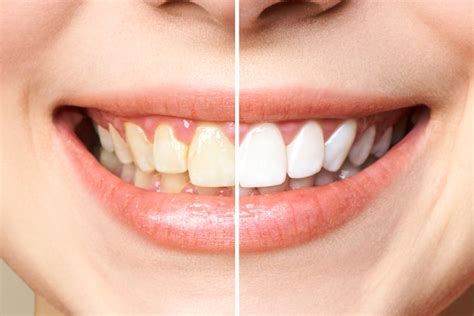 What is Dental Fluorosis, and how is it treated? - Associated Media Coverage