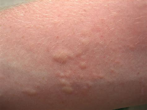 Diagnosing Skin Bumps Lumps Blisters Bug Bites - vrogue.co