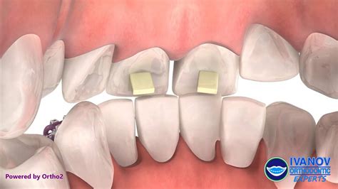 Questions You Should Ask Your Orthodontist About Bite Turbos - Blogs - WebDental, LLC