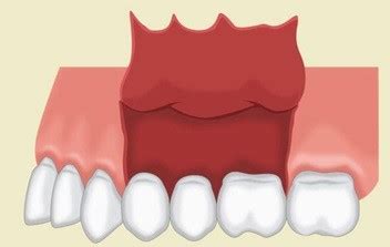 Flap Design in Dento-alveolar Surgery | LaptrinhX / News