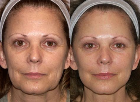 Mini Face Lift: A Quick and Convenient Beauty Hack | Mini face lift, Face lift surgery, Laser skin